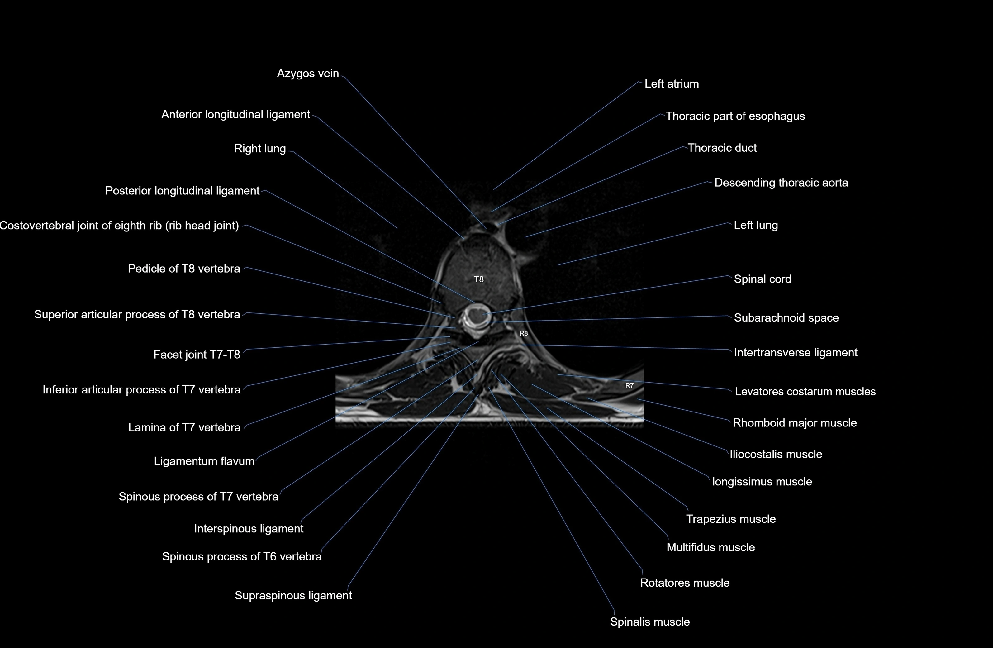 MRI thoracic spine axial  cross sectional anatomy 3T radiology  image-img-00001-00050.webp